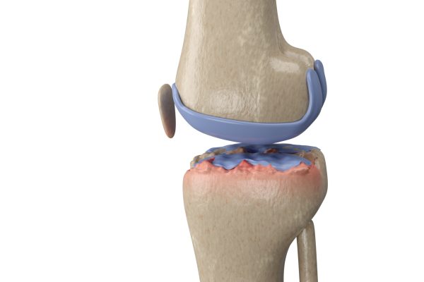 Artoprotesi del ginocchio: soluzioni personalizzate per ritrovare la mobilità